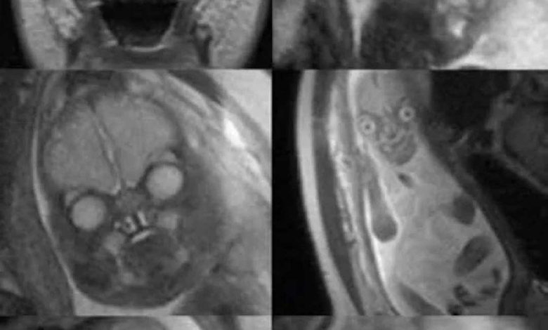 تصویر جنین انسان در رحم مادر با استفاده از MRI