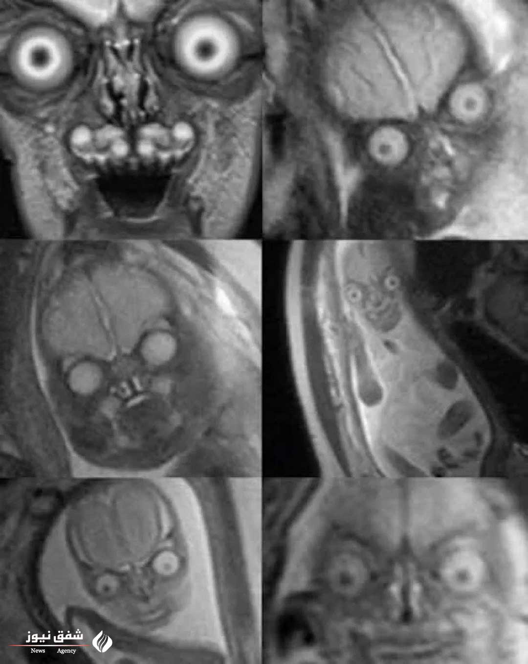 تصویر جنین انسان در رحم مادر با استفاده از MRI